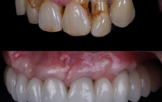 solución de enfermedad periodontal