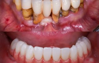 Enfermedad periodontal grave en arcada inferior