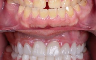 solución a mordida cruzada antero-posterior