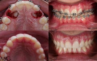 dientes incrustados en la encía