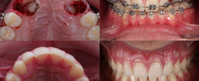 dientes incrustados en la encía