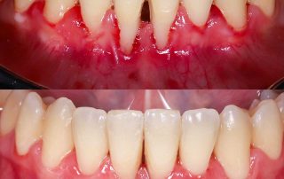 Solución a retracción de encías en zona antero-inferior