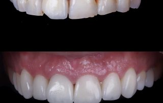 solución a abrasiones dentales con carillas dentales