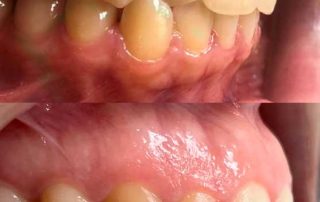 Paciente que presenta mordida cruzada de incisivo lateral superior con canino inferior