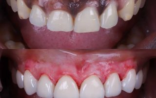 Solución encía negra con peeling de encía