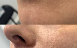 mayor volumen y perfilado de labios en Madrid