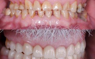 Caso clínico abrasión dental por bruxismo