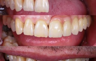 implantes dentales sin hueso