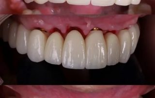 regeneración de hueso para implantes dentales sin hueso