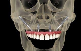 ¿Qué son los implantes cigomáticos y cuando se usan?