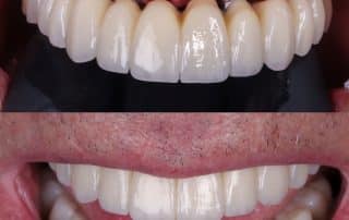 Implantes para toda la boca con prótesis fijas