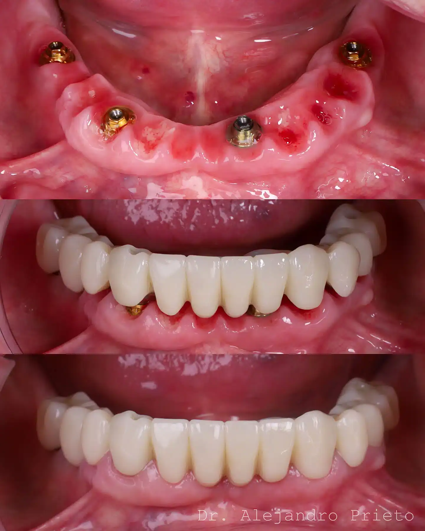 Rehabilitación de toda la boca con 4 implantes por arcada y prótesis fija