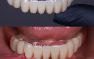 foto de dentadura fija sobre 4 implantes