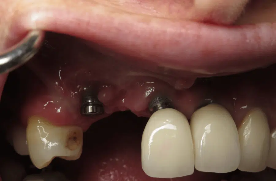 Foto de Implantes dentales mal colocados en Turkey