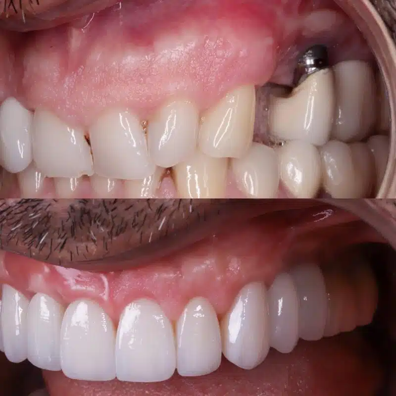 foto antes y después de implantes dentales mal colocados