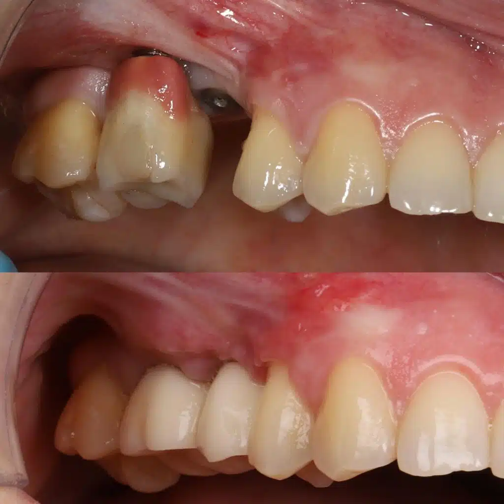 fotos antes y después de implantes dentales mal colocados