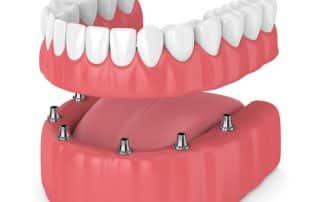 Foto de implantes all on 6