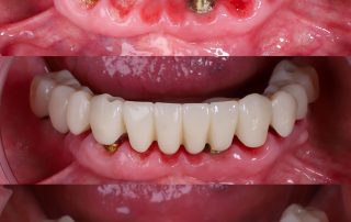 implantes dentales toda la boca all on 4
