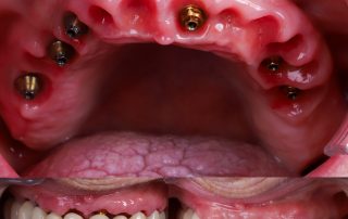 foto de implantes en toda la boca en el mismo dia con implantes de carga inmediata