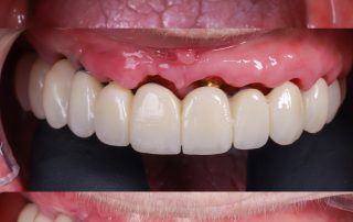 foto implantes dentales toda la boca en el día carga inmediata