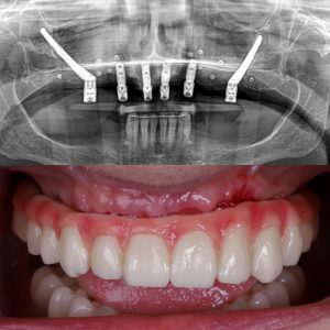 paciente sin hueso dental, solucionado con implantes cigomáticos