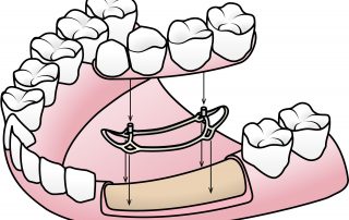 foto implantes dentales sin tornillos Subperiosteal
