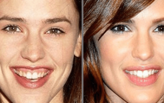 Foto antes y después sonrisa gingival jennifer garner