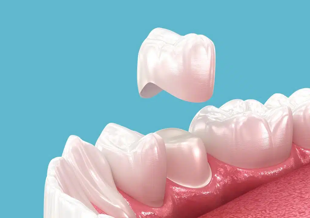 corona dental para endodoncia