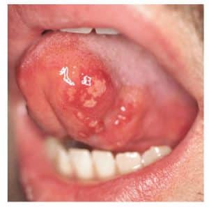 por qué salen llagas en la boca Llagas traumáticas en la lengua