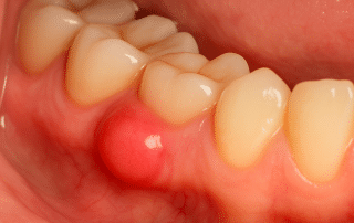 Épulis del embarazo, bulto benigno