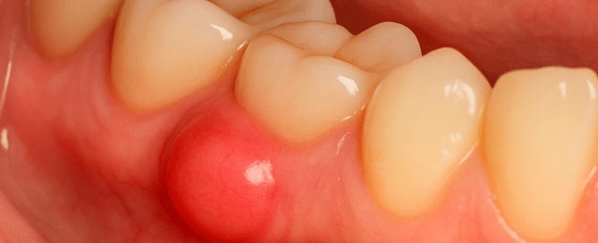 Épulis del embarazo, bulto benigno