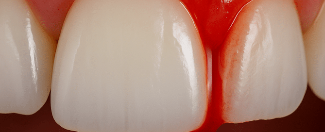 sangrado de encías en el embarazo