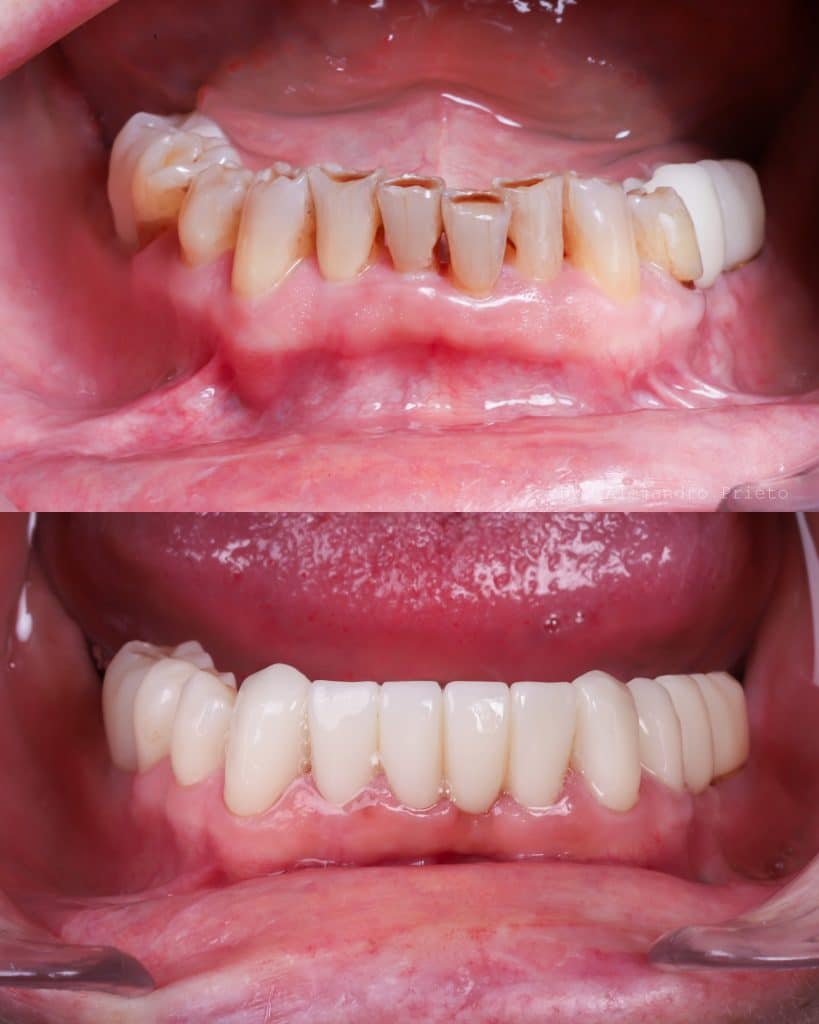 mejor clínica de Madrid con implantes dentales en el día