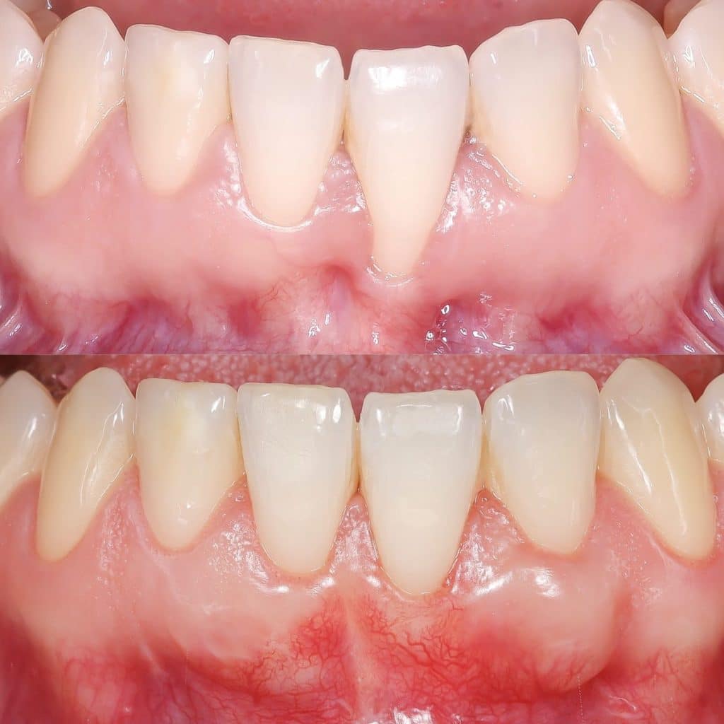 caso de recesión gingival por encías inflamadas