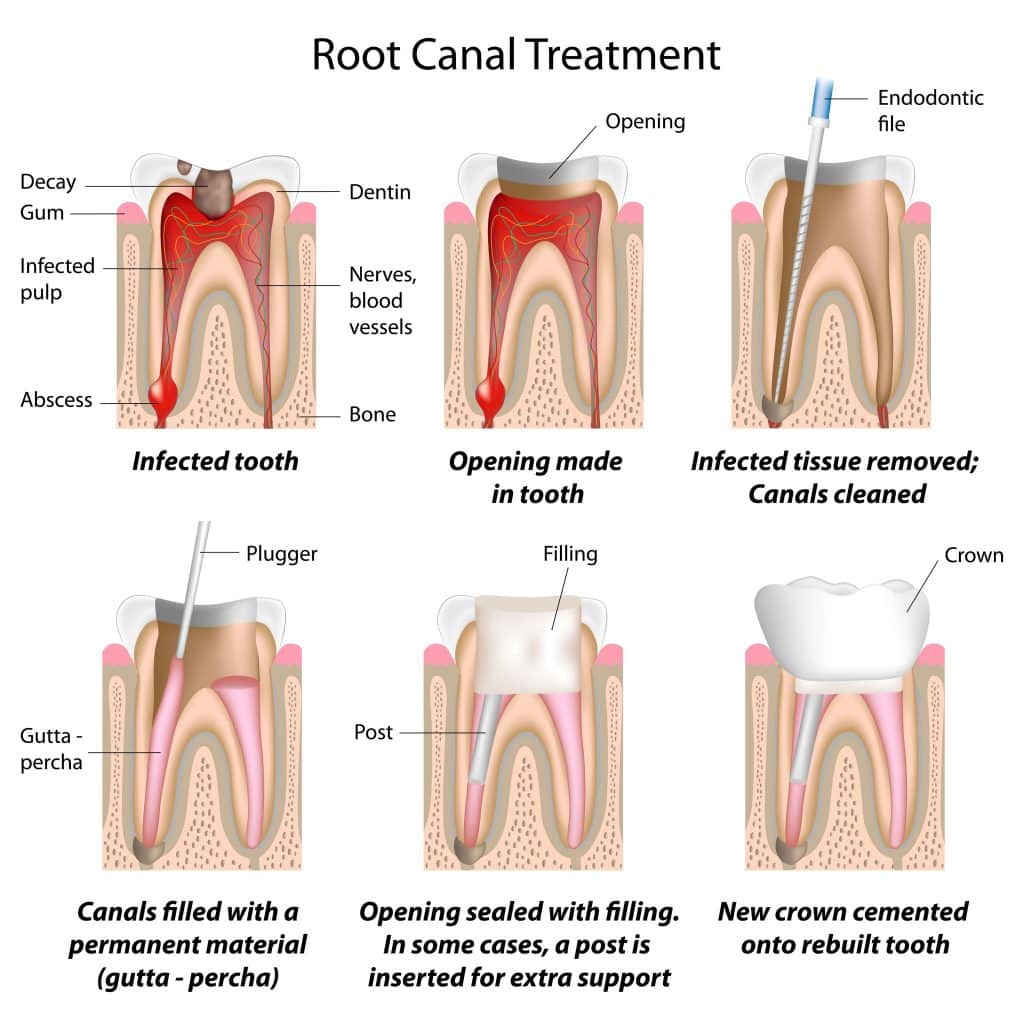 qué tomar para el dolor de muelas endodoncia