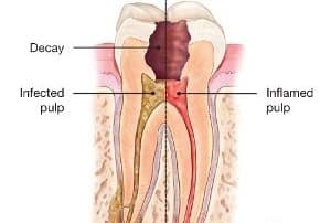 qué tomar dolor de muelas por caries