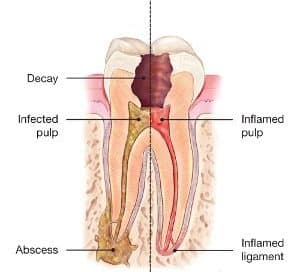 qué tomar dolor de muelas por caries