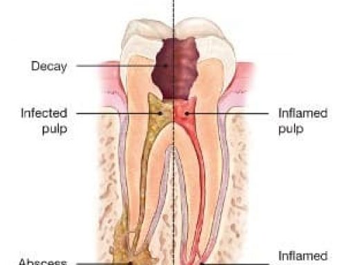 ¿Qué tomar para el dolor de muelas? te explicamos cómo calmarlo al instante