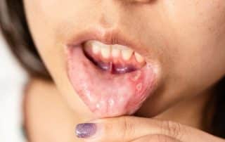 por qué salen llagas en la boca afta menor