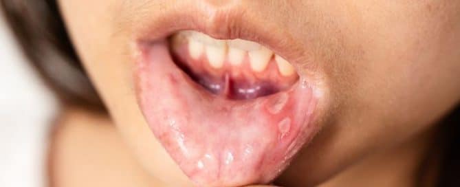 por qué salen llagas en la boca afta menor