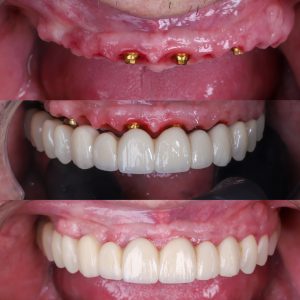 dentadura-fija-sobre-implantes blanqueamiento dental Madrid