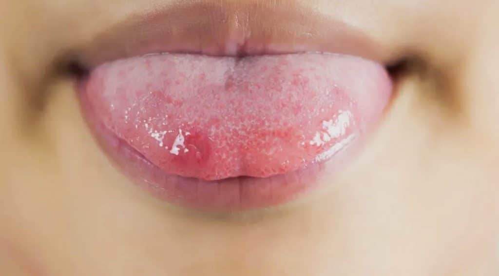 Paciente con inflamación en la lengua y cambios en el color