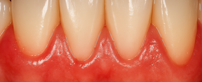 encías sanas tras blanqueamiento de encías