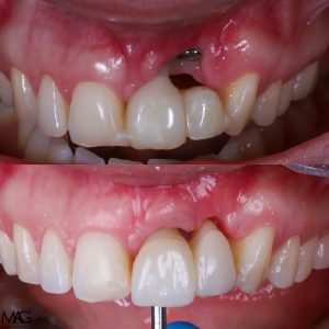 caso de hueco entre implante y encía