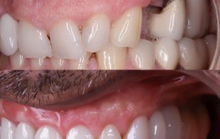 foto de implantes mal colocados con hueco entre implante y encía