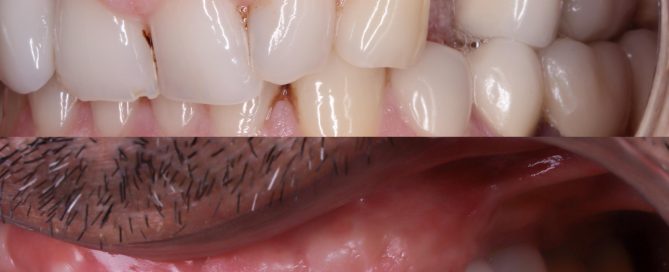 foto de implantes mal colocados con hueco entre implante y encía