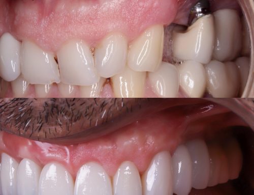 Hueco entre implante y encía: causas y soluciones