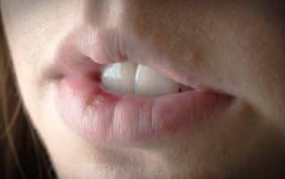 Primer plano de un labio con ampolla de herpes labial mostrando enrojecimiento e inflamación
