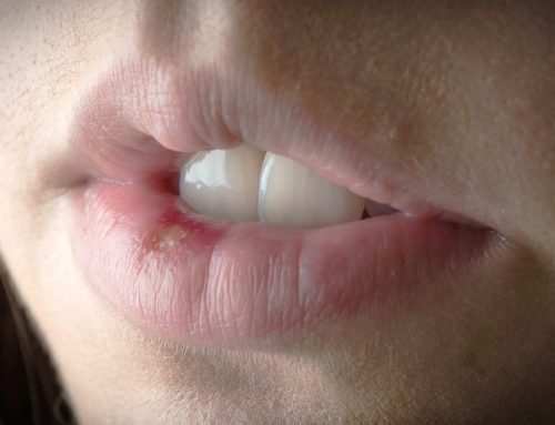 Herpes labial: causas, síntomas y tratamientos