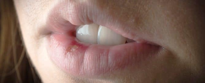 Primer plano de un labio con ampolla de herpes labial mostrando enrojecimiento e inflamación